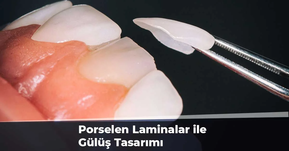 Kartal Diş Doktorunda Porselen Laminalar ile Güzel Gülüşler Elde Etmek Mümkün!