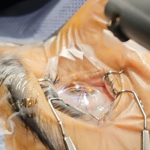 Göz sağlığına dair önemli bir katkı sağlayan Lasik ameliyatı, miyop,