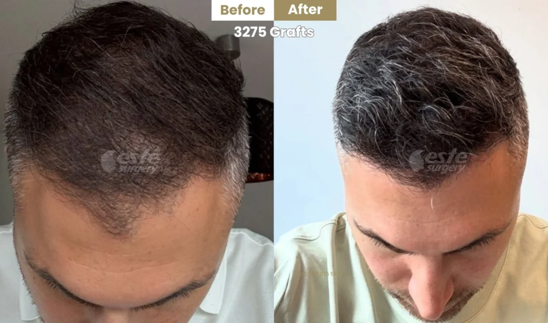 Saç dökülmesi yaşayan bireyler için en çok tercih edilen modern